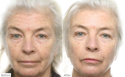 A before and after real result of a woman’s face after using Neo-FILLER.