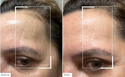 A before and after real result of a woman’s forehead area after using Neo-FILLER.