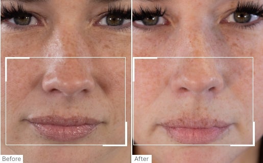 A before and after real result of a woman’s nose and mouth area after using Neo-FILLER.